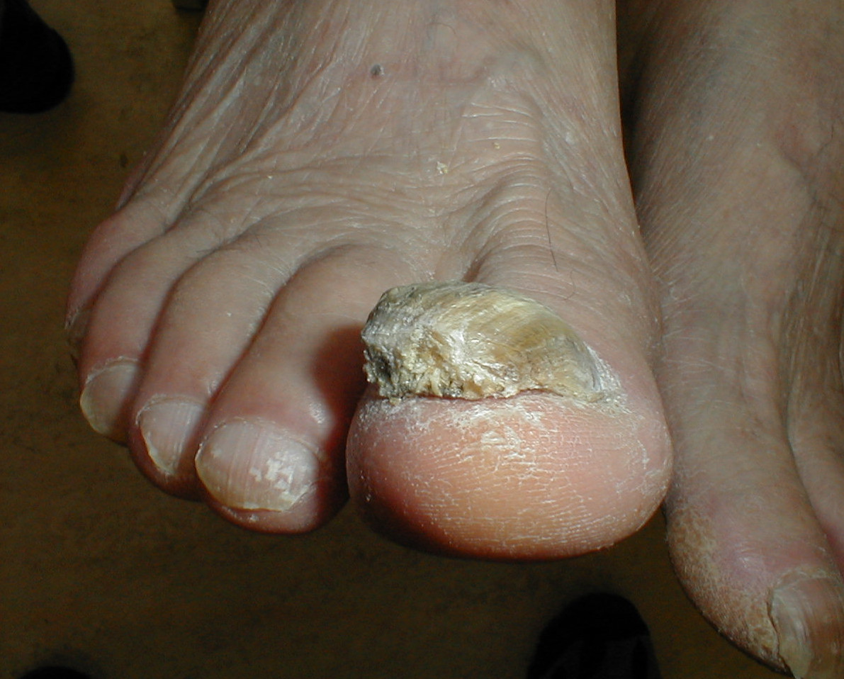 Why do I need to test my fungal nail? - West Berkshire Foot Clinic